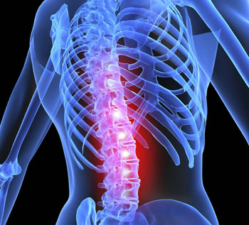 Spine Surgery Attorney | Deskin Law Firm